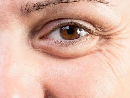 Does Eye Bag Removal Improve Skin Texture?