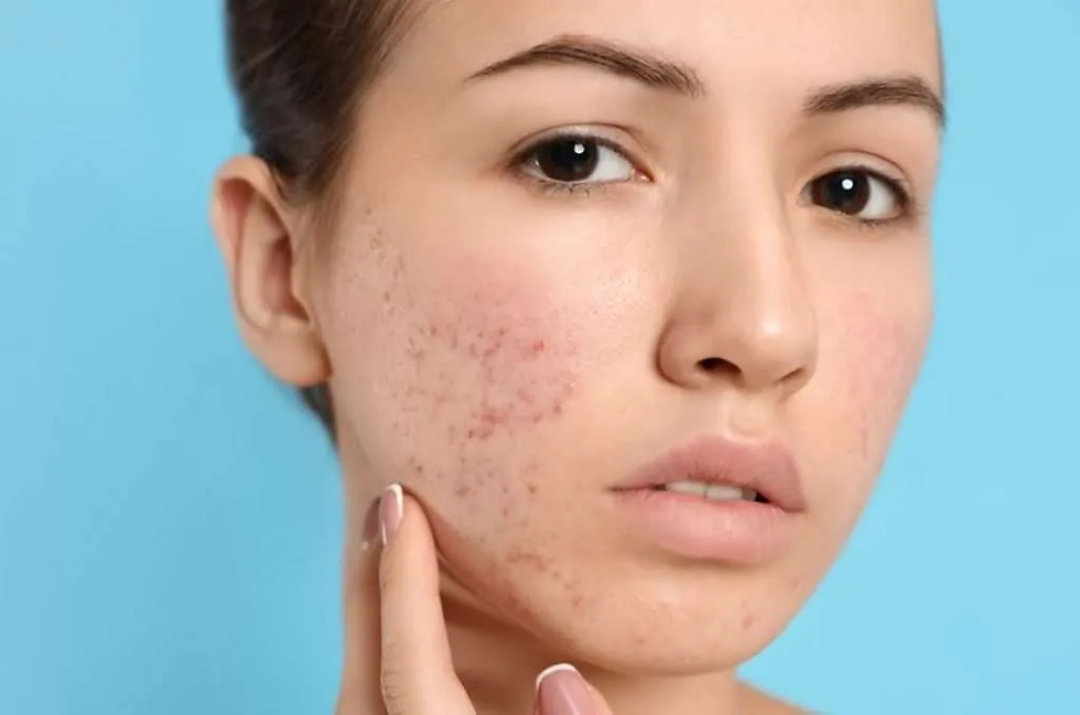 How Many Sessions Are Needed for Acne Scar Improvement?