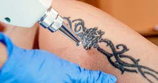 Picosure Tattoo Removal for Colored Inks in Dubai