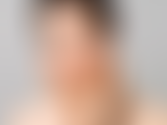 Is Sculptra Fillers Good for Volume Loss?