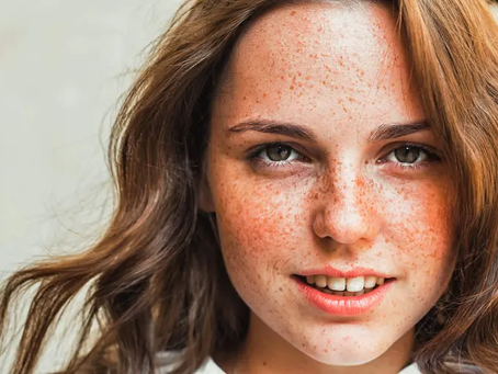 Are Freckles And Blemishes The Same?