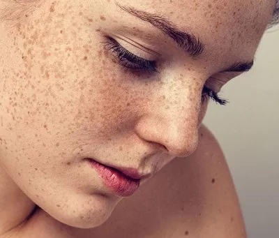 Are Laser Treatments Effective for Freckles and Blemishes?