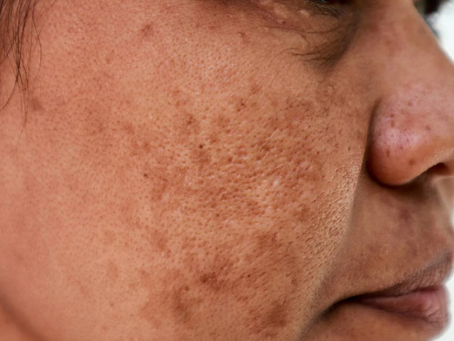 What Causes Skin Pigmentation Issues?