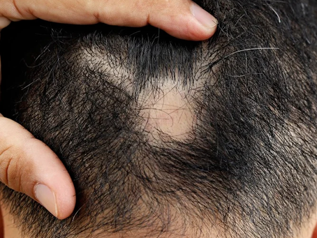 How Does Alopecia Areata Treatment Work for You?