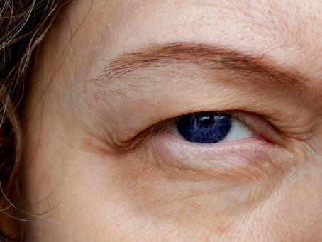 Can Erbium Peeling Be Done Around the Eyes?