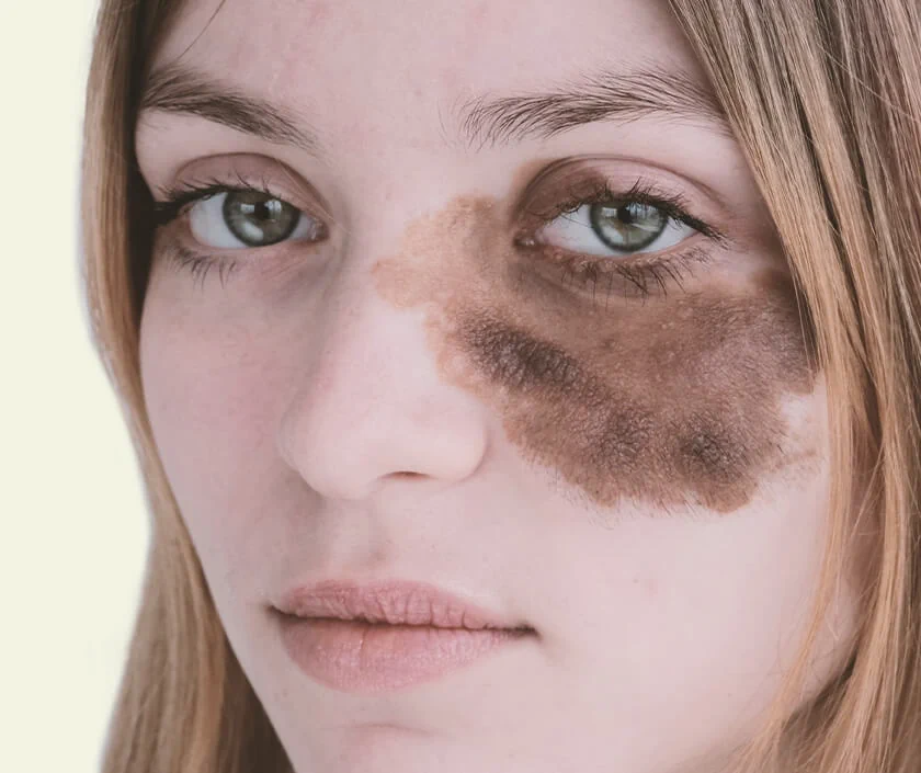 Is Birthmark Removal Safe for All Skin Types?