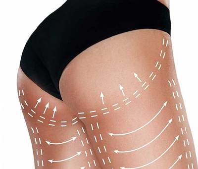 Is Buttock Augmentation for All Body Types?