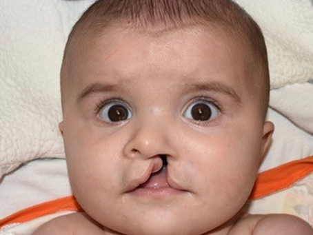 What is Palate Repair Surgery and How Does It Work?