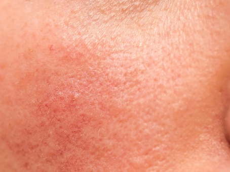 Can Rosacea Treatment Boost Self-Confidence?
