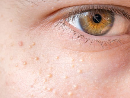 Best Milia Treatments for Facial Bumps