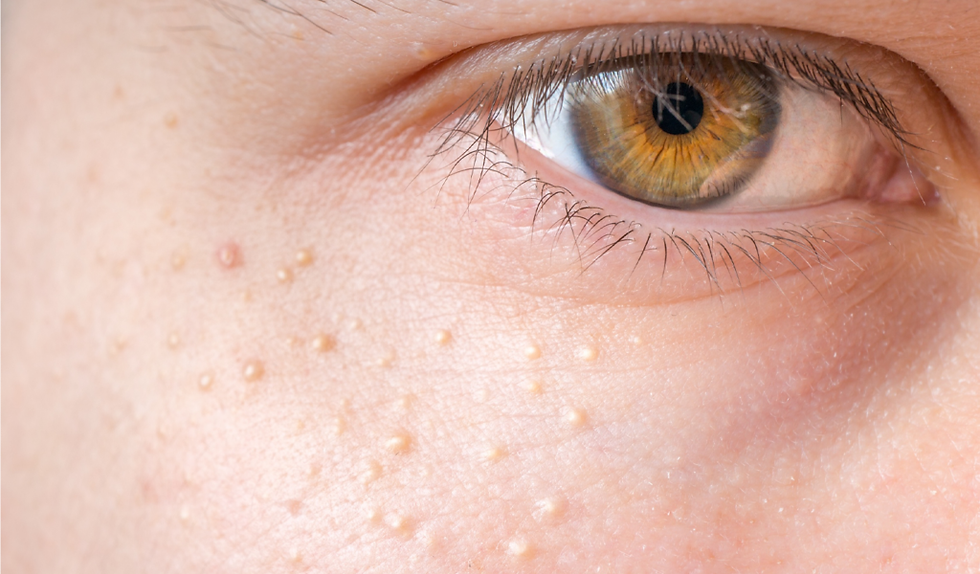 Best Milia Treatments for Facial Bumps