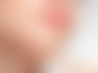 Laser Lip Reduction: A Painless Approach