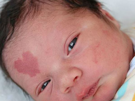 Is Birthmark Removal Safe for All Skin Types?