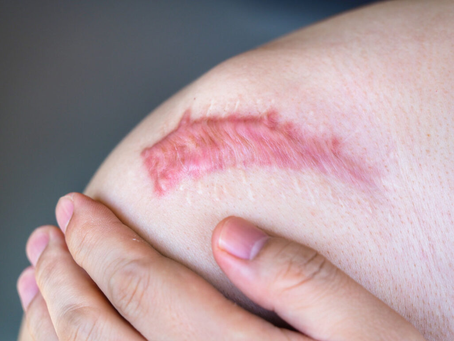 Can Keloid Treatment Completely Remove Scars?