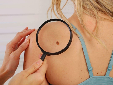 Is Dermoscopy Mole Evaluation Safe?