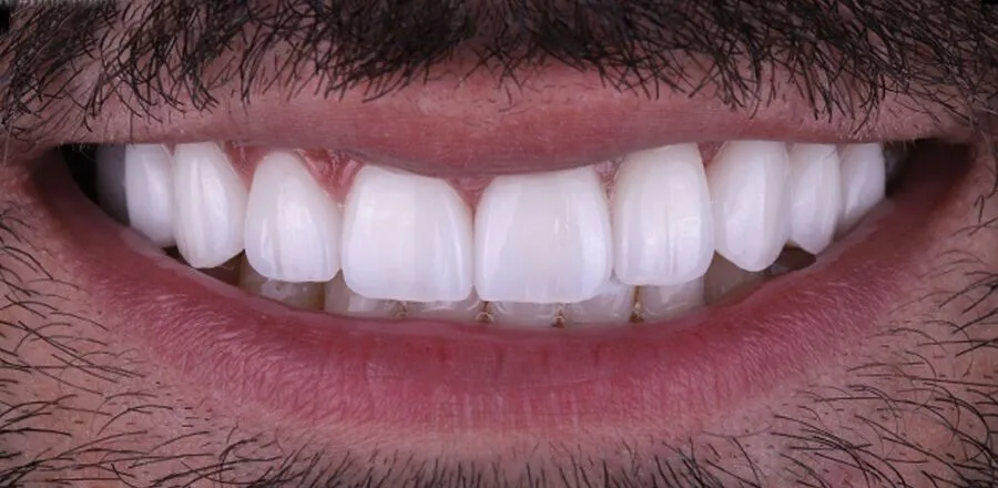 Do Composite Veneers Look Natural?