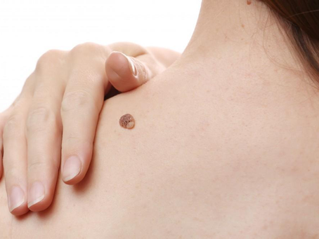 How Effective Is Mole Removal for Moles on the Face?