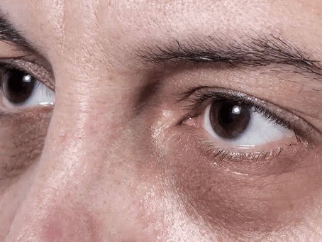 How to Combine Skincare with Dark Circles Treatment?