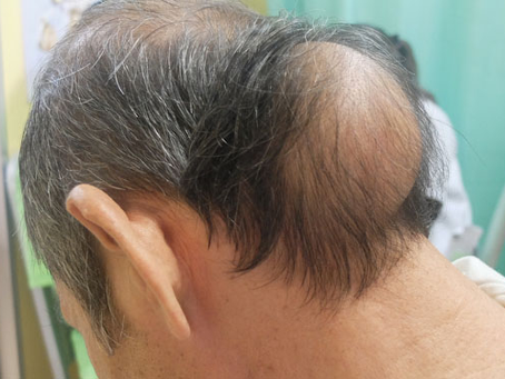 Lipoma Complications: When to Worry
