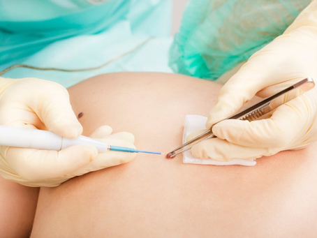 How Effective is Mole Removal for Facial Moles?