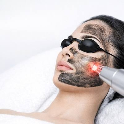Can Laser Carbon Peel Minimize the Appearance of Large Pores?