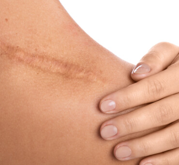 Who Can Benefit From Skin Camouflage?