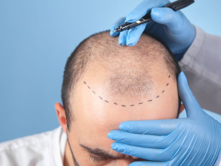 Can Crown Hair Transplant Work On Curly Hair Types?