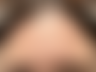 Can Botox Help Minimize Forehead Lines and Wrinkles?
