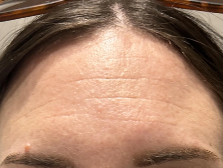 Can Botox Help Minimize Forehead Lines and Wrinkles?
