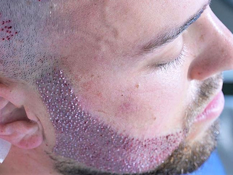 Does Beard Hair Transplant Leave Permanent Scars?