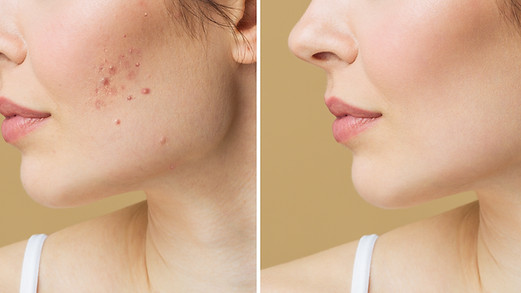 Young woman before and after acne treatment. Skin care concept..jpg