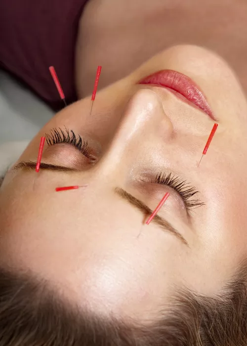 acupuncture