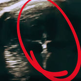 A ecografia mostrou a imagem de Jesus na Cruz e o aborto foi descartado