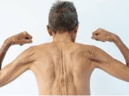 Sarcopenia: o inimigo invisível da sua saúde muscular