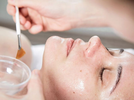 TCA peels (Advanced Exfoliation)