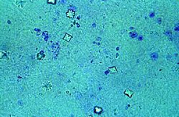 250px-Calcium_oxalate_crystals_in_urine.