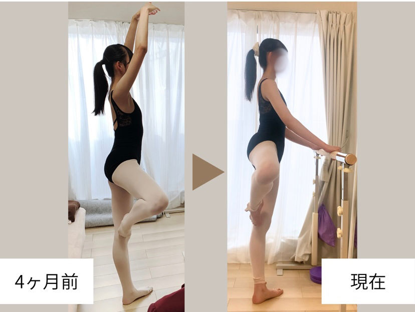 10代・クラシックバレエダンサー・4か月後のビフォー・アフター改善例|パッセ・アンディオール・軸のパフォーマンスの激的向上