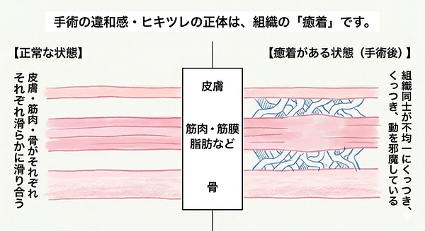手術後の滑走不全による可動域制限、違和感、ひきつれ、の原因となる組織同士の癒着の図解。正常な状態では、皮膚・筋・骨などを包むファシア組織が滑り合うのに対し、癒着がある状態では、組織間のファシア同士が不均一にくっつき、動き、滑走性を邪魔しているして様子を解説。