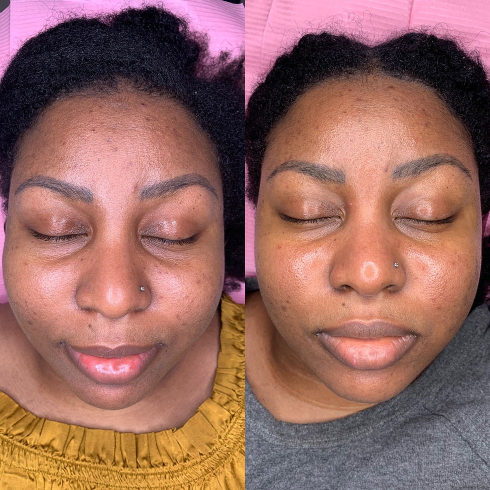 Miniature : Microdermabrasion Régulier