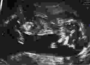 Liam's First Sonogram