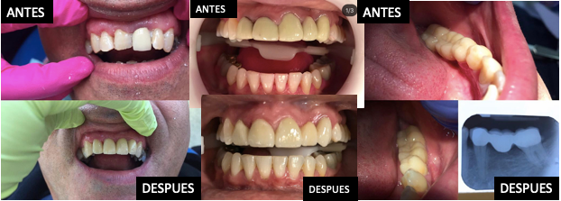 Protesis Parcial Fija (PPF)