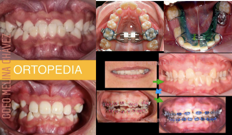 Ortodoncia y Ortopedia Maxilar