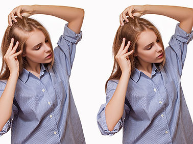 Women-Hair-Transplant-01.jpg