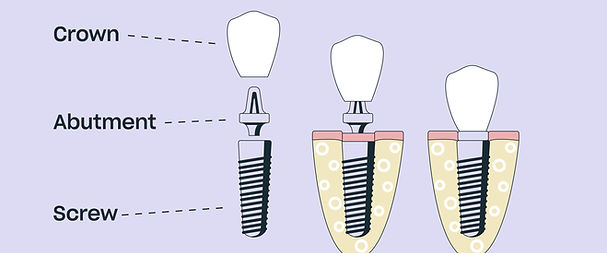 1629800594-dental-implant-1427573001.jpeg