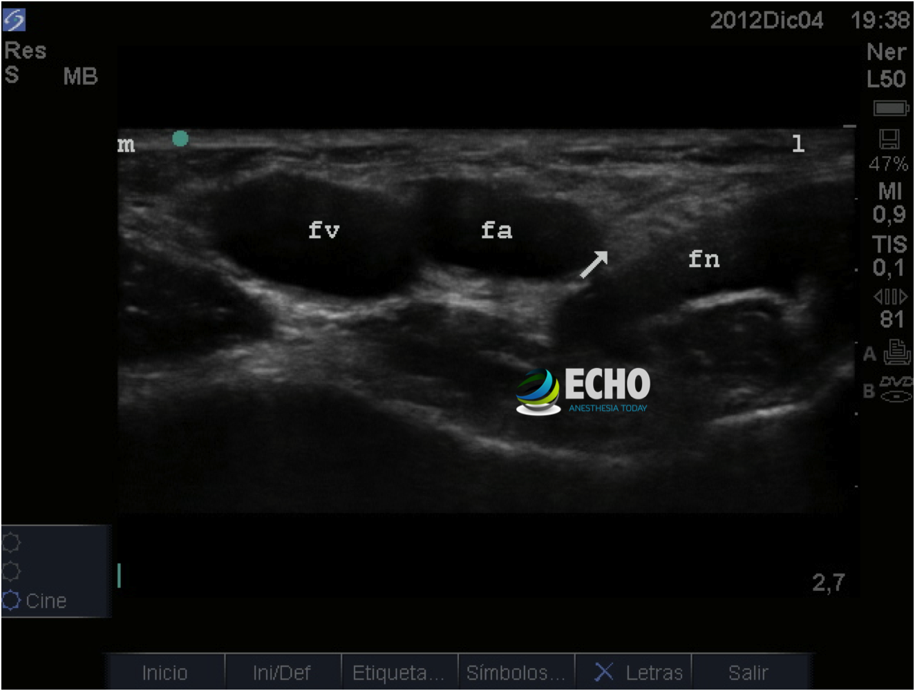 Femoral Block
