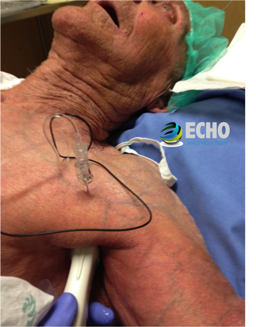 infraclavicular-axillary block