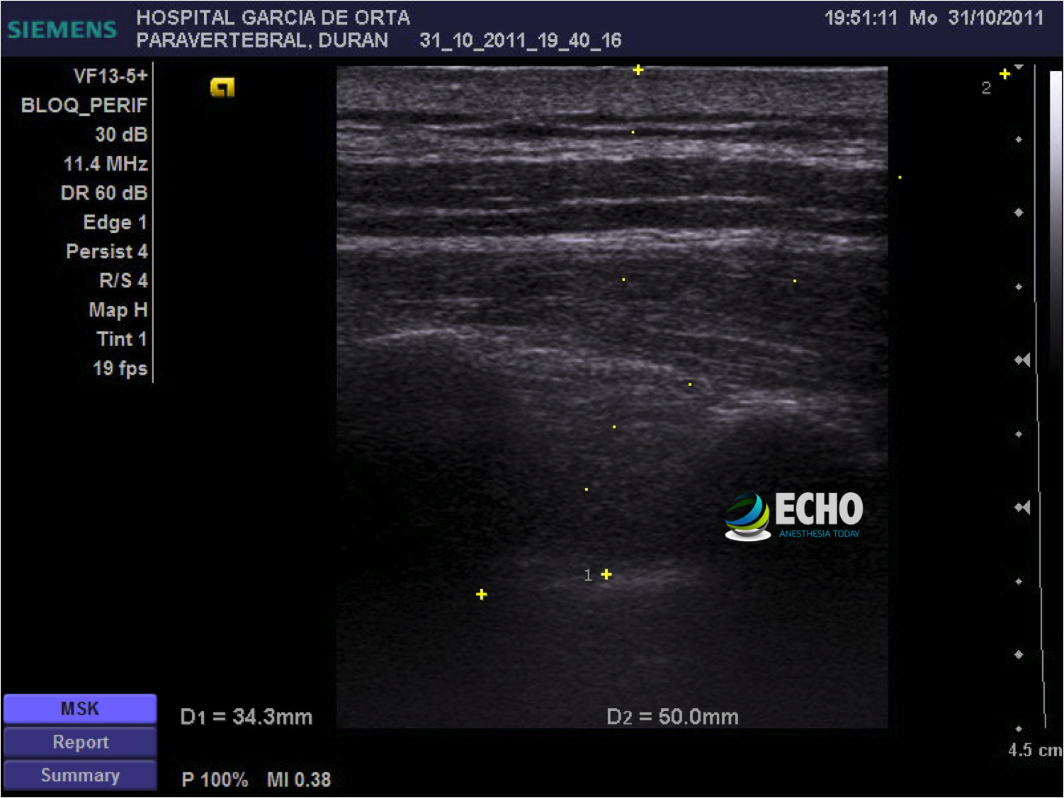 Paravertebral Block