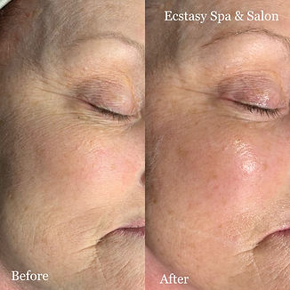 Laser Skin Tightening