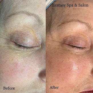 Laser Skin Tightening