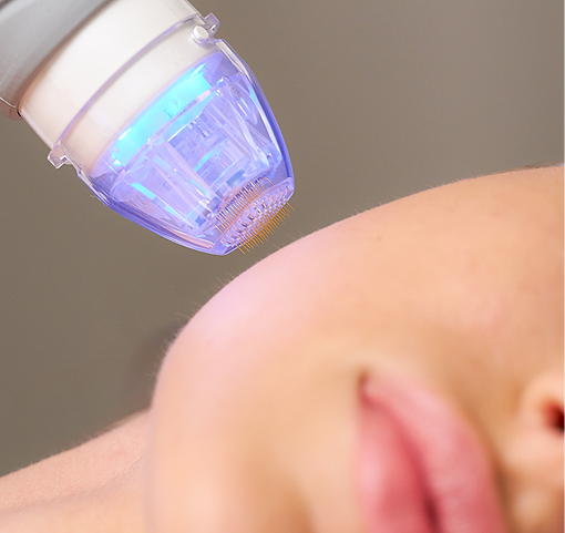 Combine microneedling with radiofrequency for deeper skin remodeling.